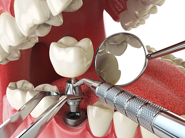 Emergency Dental Filling Replacement in IL